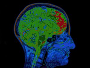 highwaystarz150800302.jpg - mri image of head showing brain