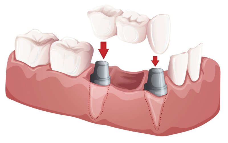 dental bridge_fotoco