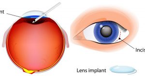 Cataract Surgery. Steps laser cataract surgery