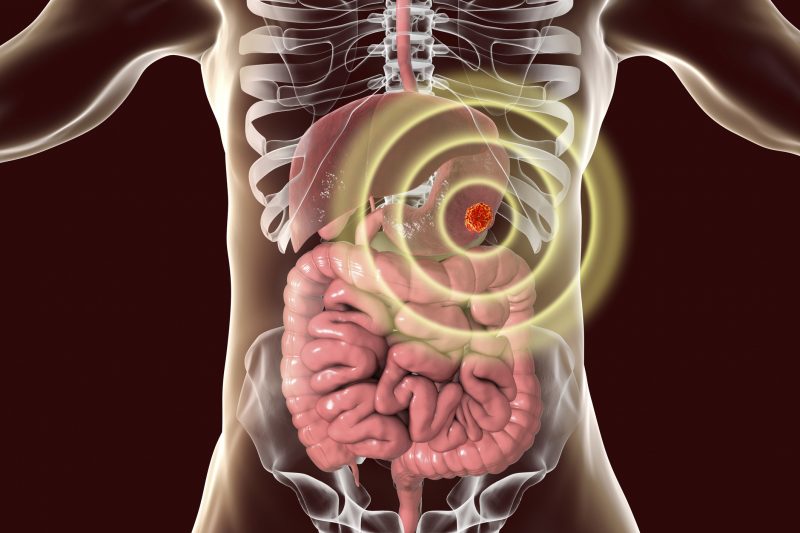胃がんのイメージ図