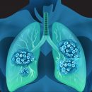 肺がんになっている人体のイメージ