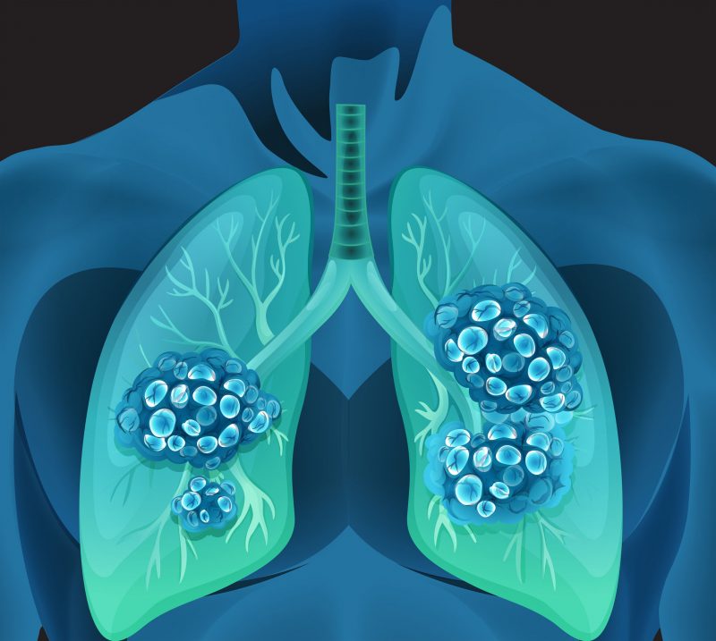 肺がんになっている人体のイメージ