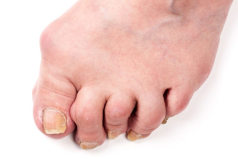 痛風で親指の付け根が腫れている足