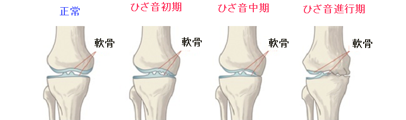 変形性膝関節症の進行を示すイラスト