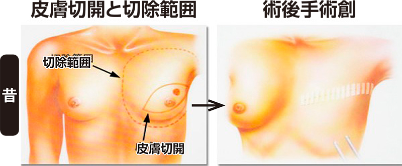 昔の乳がん手術。皮膚切開と切除範囲、術後手術創のイラスト画像