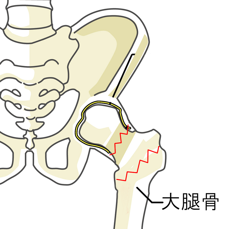 大腿骨近位部骨折が起こる場所の図解