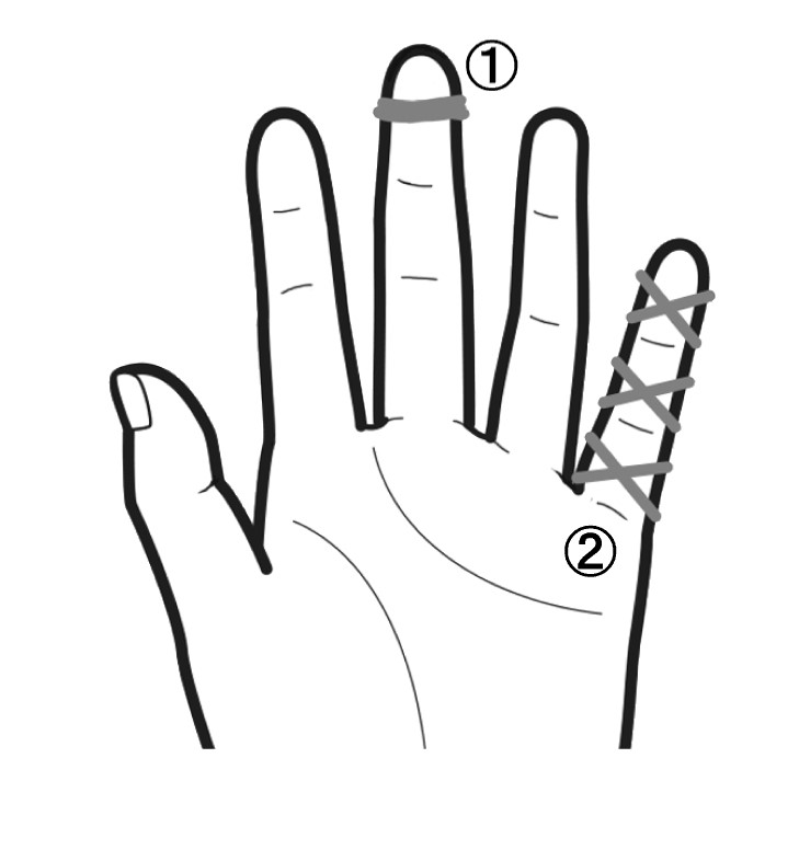中指の爪先、小指の第1、第2、第3関節に輪ゴムを巻いた手のひらイラスト