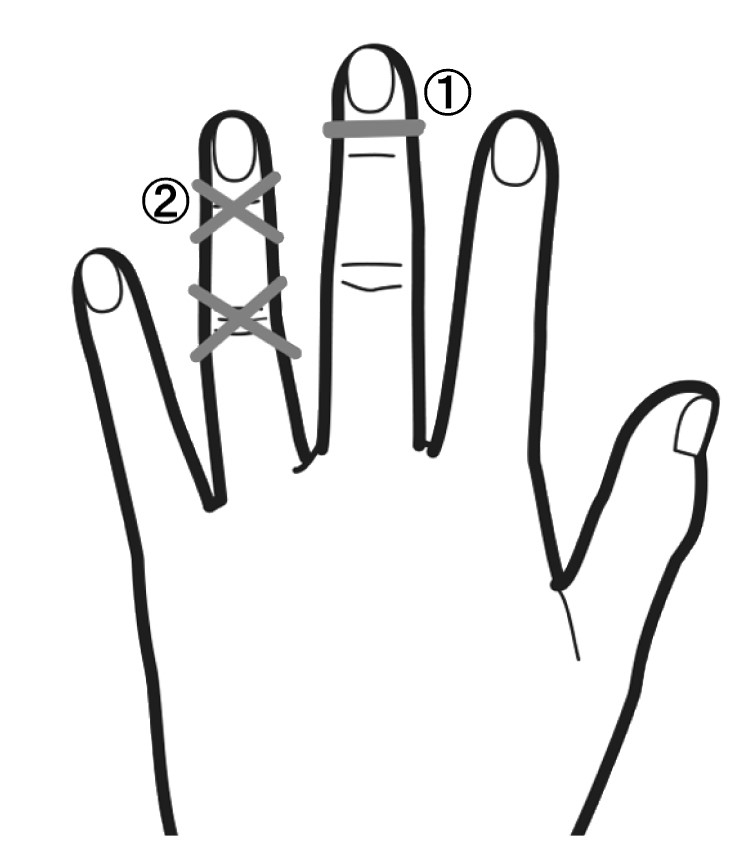 中指の爪の下と、薬指の関節部分に輪ゴムを巻いた手の甲のイラスト