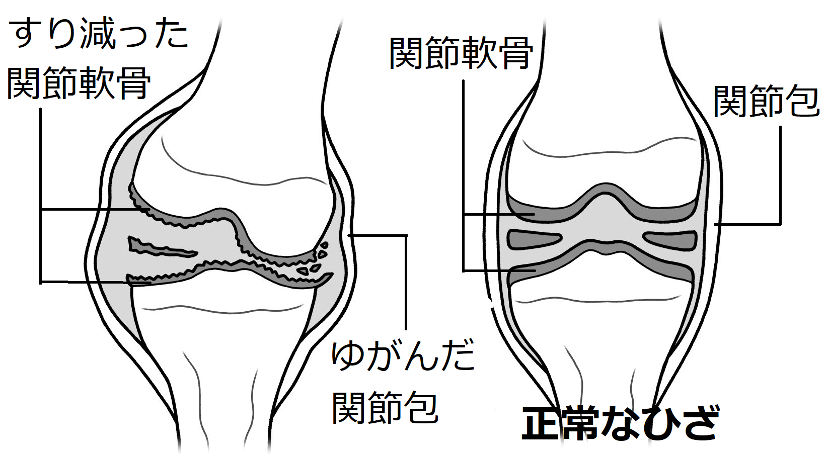 正常な状態のひざと痛みの出たひざを図解している