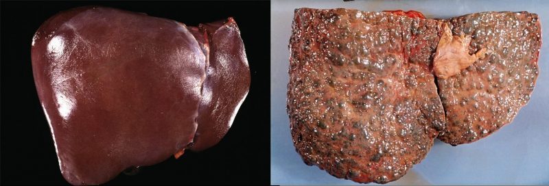 健康な肝臓と肝硬変になった肝臓を比較