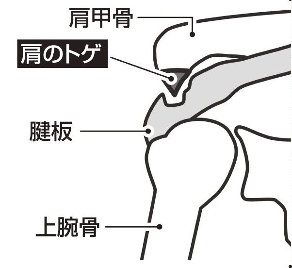 肩のトゲの位置を図解