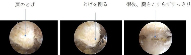 「肩関節鏡視下手術」の術前術後の内視鏡映像