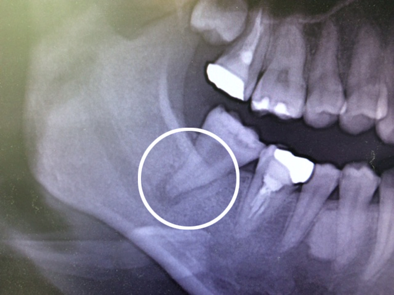 MI治療による虫歯治療の例