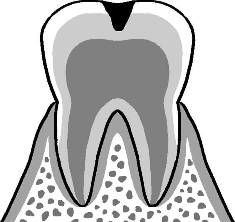 エナメル質の内側の象牙質まで進行している虫歯。