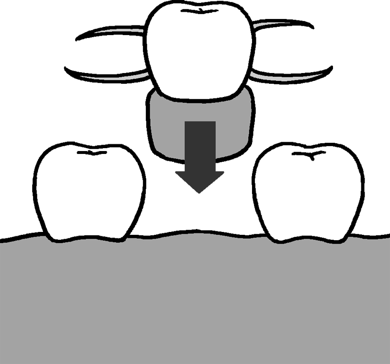 取り外し可能な人工歯で補う方法。「入れ歯」
