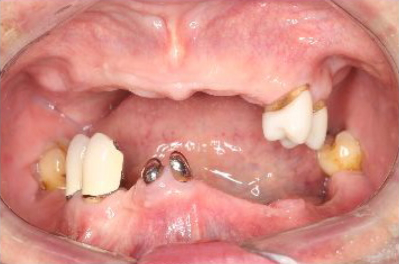 入れ歯の治療例