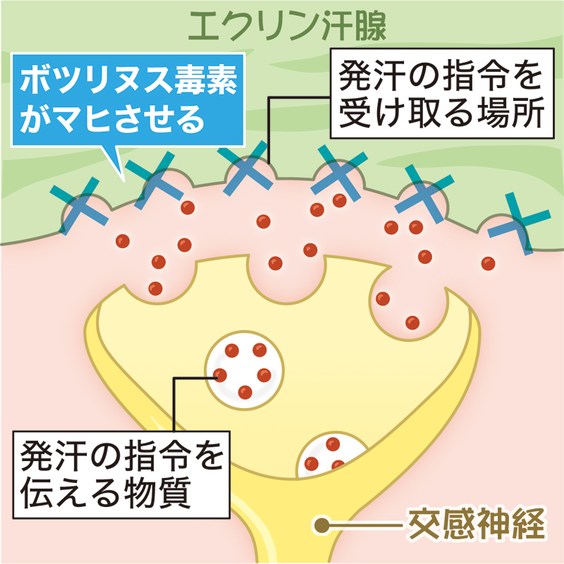 ボトックス注射がわきの汗を抑える仕組みを解説した図