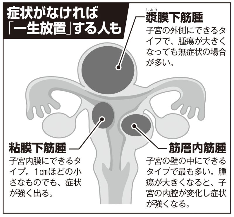 子宮筋腫を図解したイラスト
