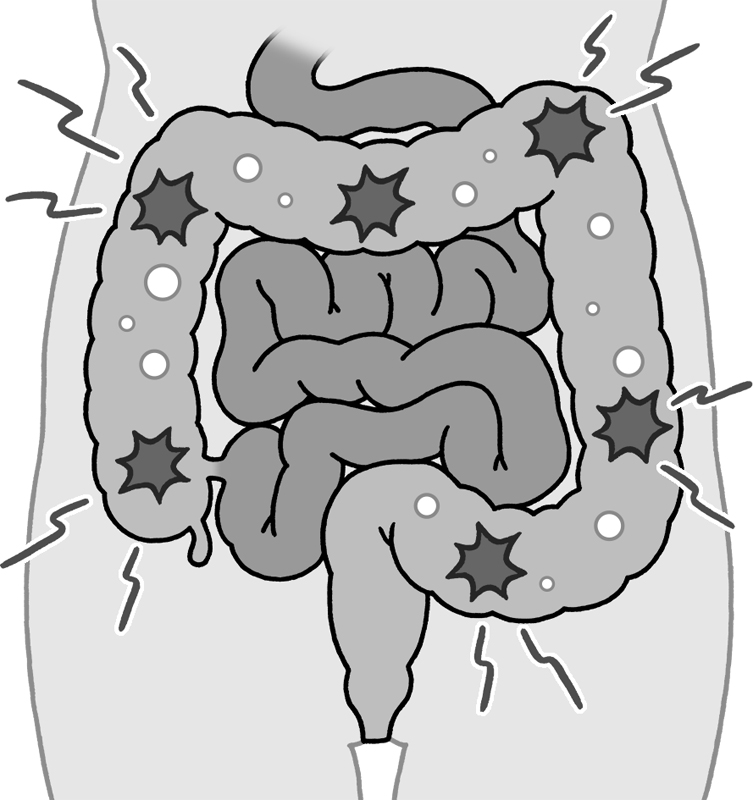 腸の中のイラスト 便秘イメージ
