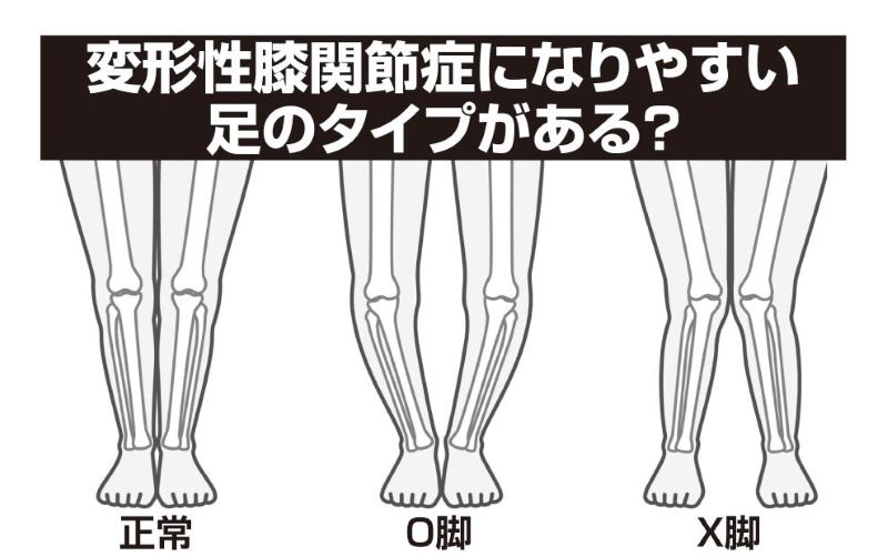 正常な足の骨、O脚の骨、X脚の骨のイラスト