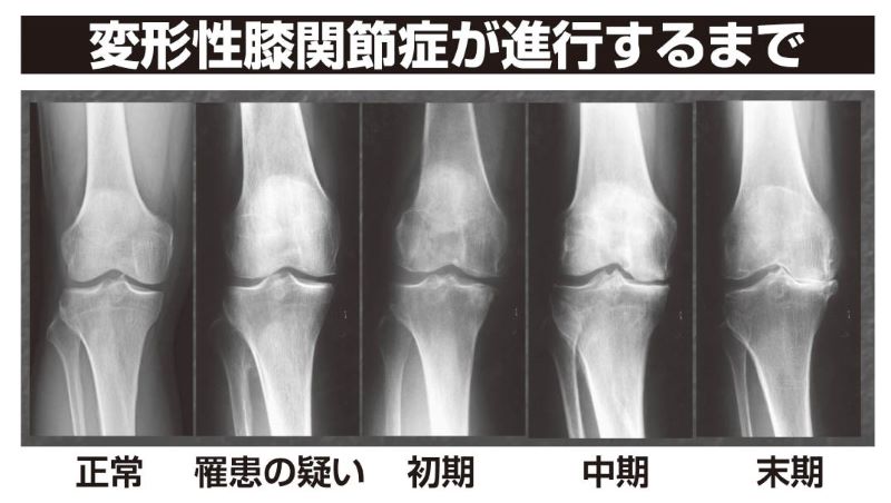 変形性膝関節症が正常から末期まで進行するまでの骨のレントゲン画像