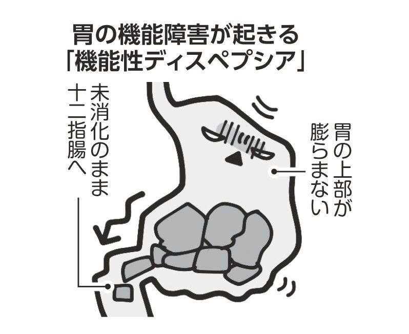 機能性ディスペプシアの胃