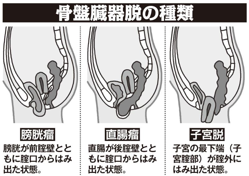 骨盤臓器脱の種類３パターンの図解