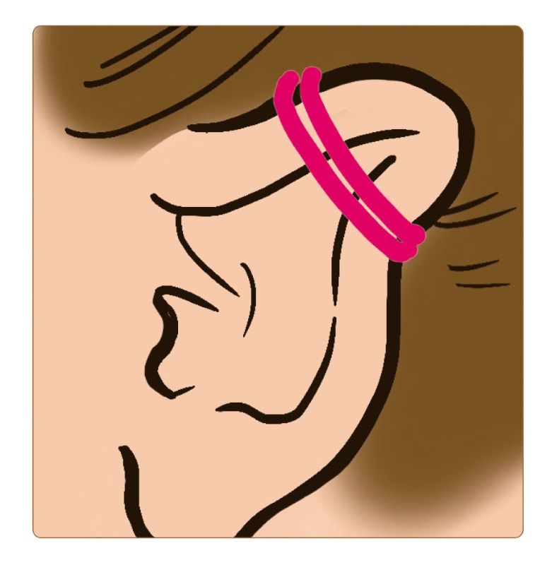 耳の上部に輪ゴムを二重に巻き付けた女性の耳のイラスト