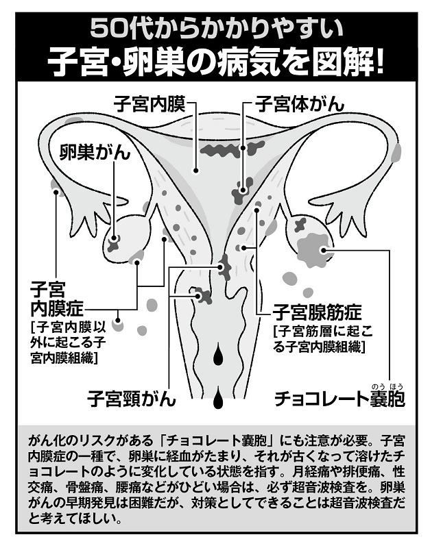 子宮・卵巣の病気を図解！