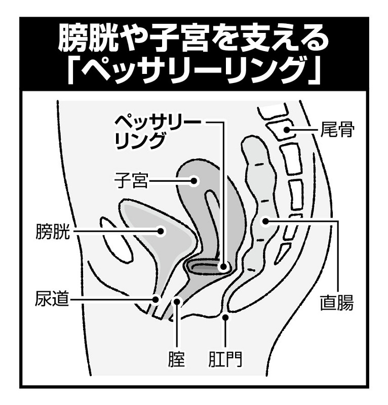 膀胱や子宮を支える「ペッサリーリング」