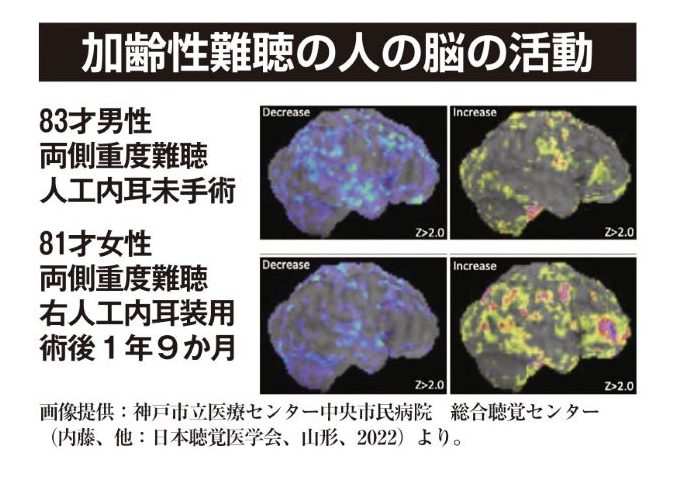 加齢性難聴の人の脳の活動の画像4種