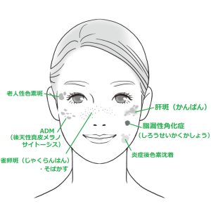 シミの位置と名前