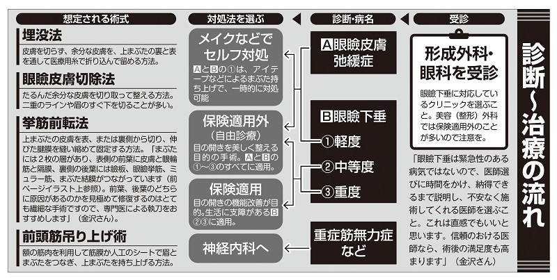 眼瞼下垂診断～治療までの流れ