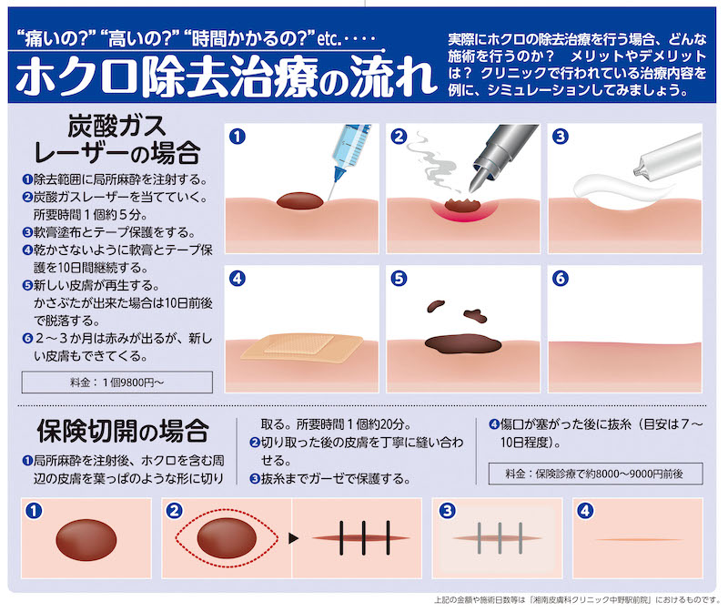 ホクロ除去治療の流れ