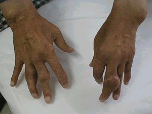 手の関節に痛風を発症。指が変形するほど腫れているのがわかる。（写真／両国東口クリニック）
