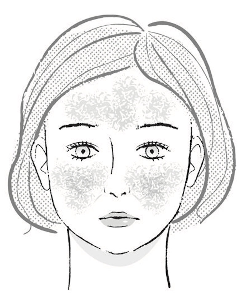 皮膚の毛細血管が広がって顔が赤くなり、ほてりやヒリヒリ感を伴う