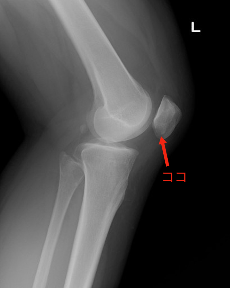 左ひざの膝蓋骨（矢印部分）が少しずれて隙間が狭く、切り立っているように見える