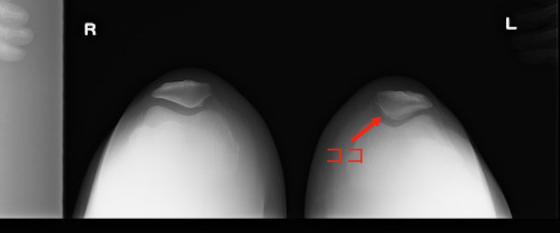 右ひざ（左）は、大腿骨と膝蓋骨の隙間がくっきりだが、左ひざ（右）の隙間（矢印部分）はぼんやり（写真／関町病院提供）