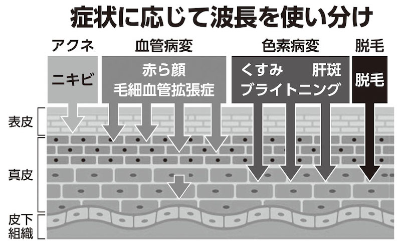 症状に合わせて光の波長を使い分けることが可能