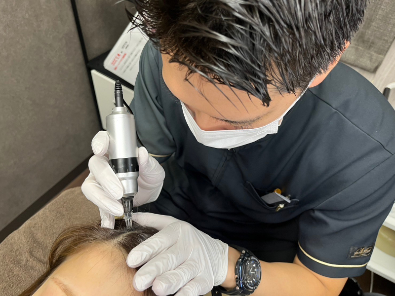 FIXERを施術する田中さん。頭皮に針を挿入するが痛みはないため、麻酔の必要はない。