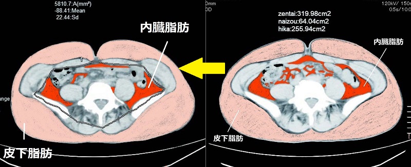 内臓脂肪、皮下脂肪ともに面積が減少している