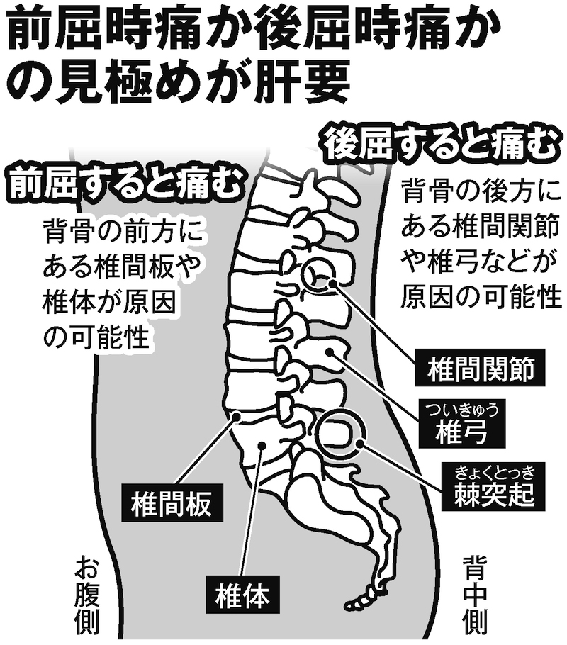 腰の痛みは、「体を後ろに反らす（後屈する）と痛い」場合と「前屈すると痛い」場合をまずは確認