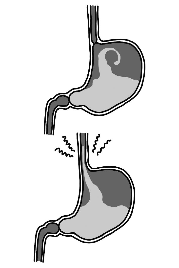 逆流性食道炎の図