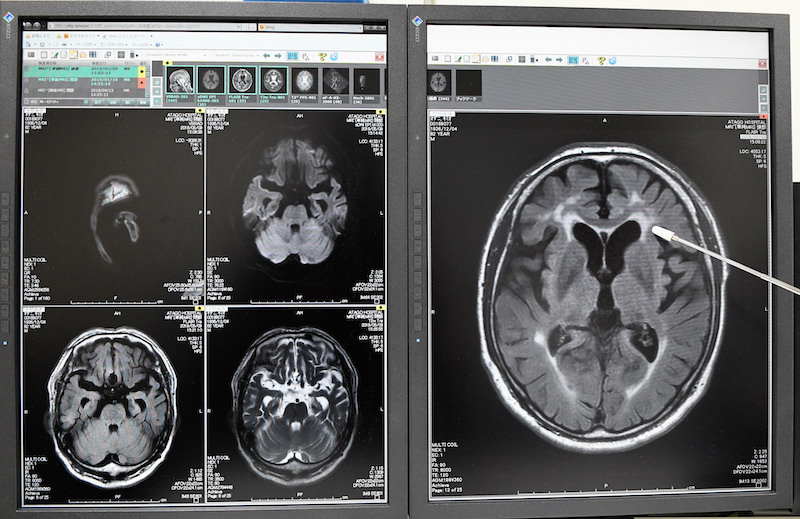 白質病変を指し示す朴医師