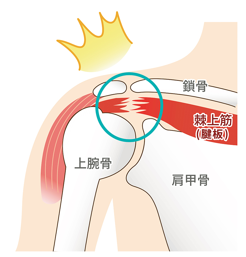 腱板断裂