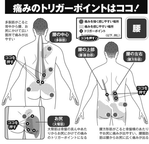 【トリガーポイント】とは?腰・背中の痛みのトリガーポイントの探し方・ほぐし方をわかりやすいイラストで解説|「痛みの駆け込み寺」と称されるペインクリニック医師が指南